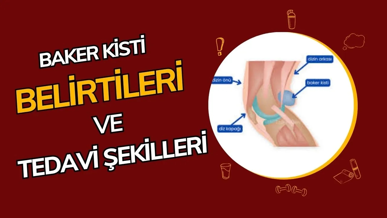 Baker Kisti Nedir? Diz Arkasındaki Şişliğin Sebepleri ve Tedavi Yöntemleri