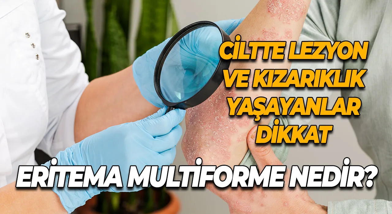 Ciltte Lezyon ve Kızarıklık Yaşayanlar Dikkat Eritema Multiforme Nedir?
