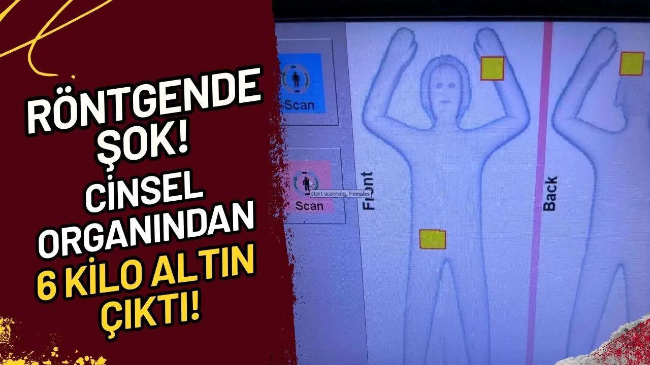 Röntgende Şok! Cinsel Organından 6 Kilo Altın Çıktı!