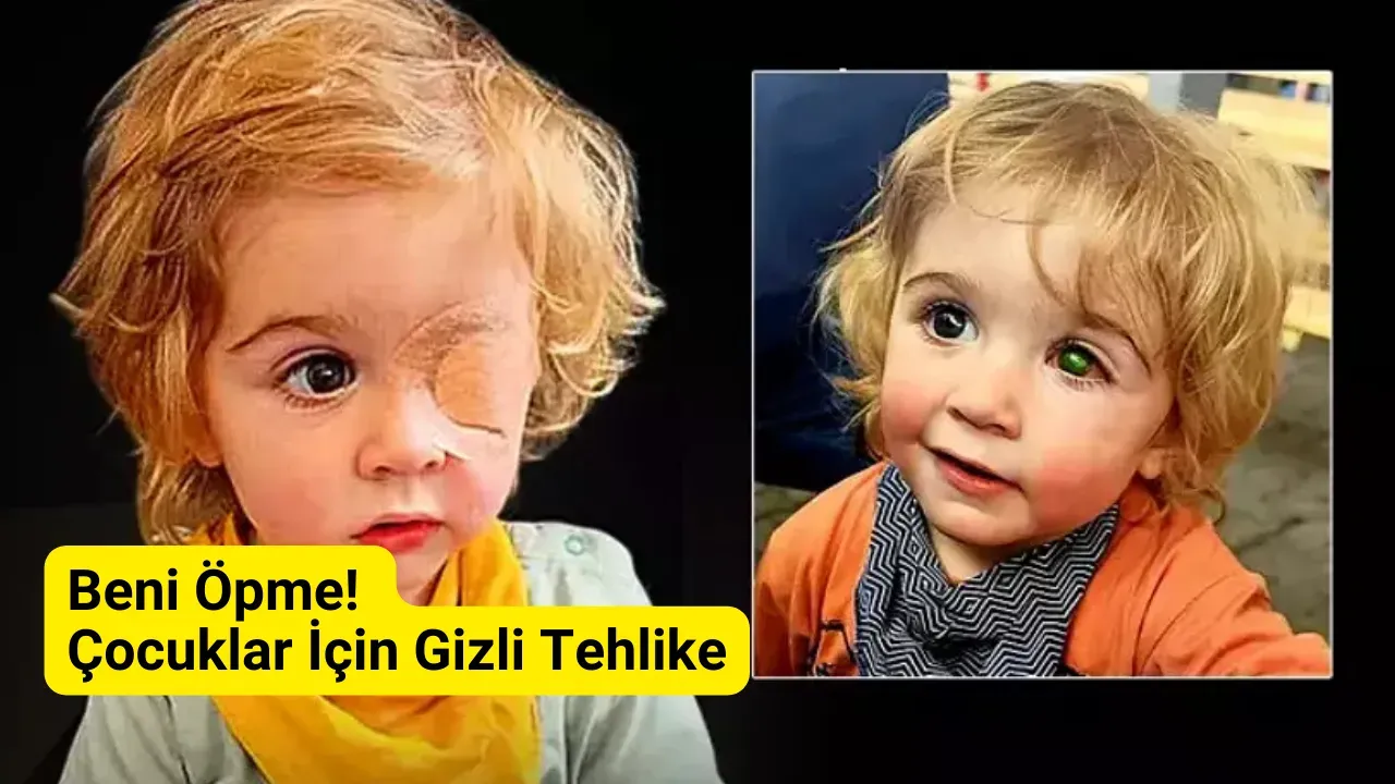 Image for Çocukları Öpmeyin! HSV Virüsü Kör Etti (Dikkat!)