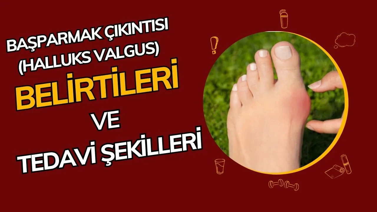 Başparmak Çıkıntısı (Halluks Valgus) Nedir? Ayak Sağlığını Tehdit Eden Yaygın Deformite