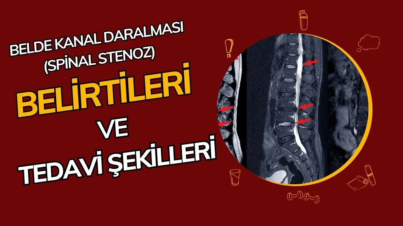 Belde Kanal Daralması (Spinal Stenoz) Nedir? Çağımızın Ağrı Kaynağı ve Çözüm Yolları